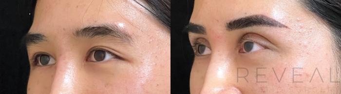 Before & After Eyelid Surgery Case 677 Right Side View in San Jose, CA