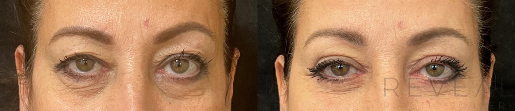 Before & After Eyelid Surgery Case 716 Front View in San Jose, CA