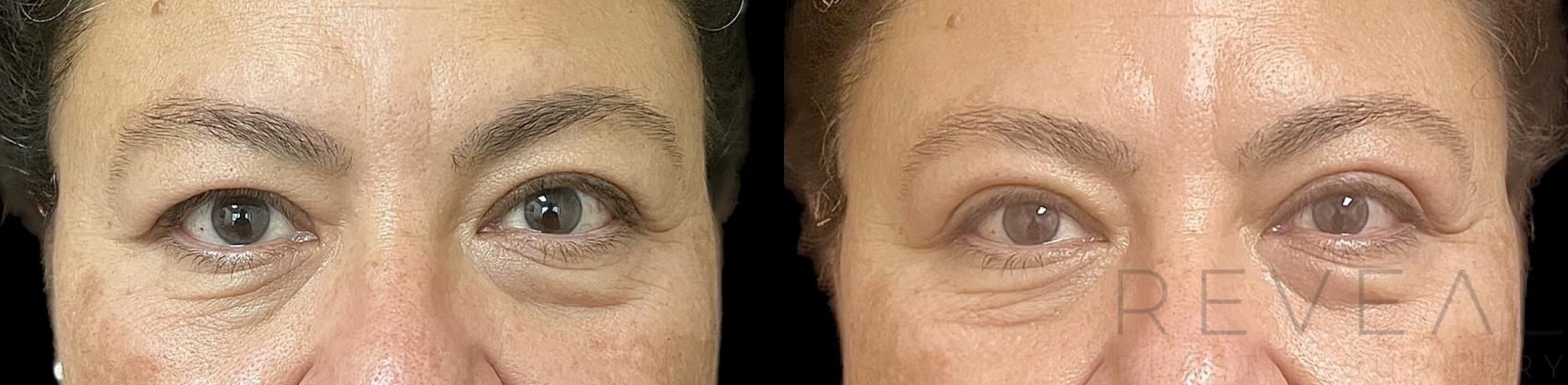 Before & After Eyelid Surgery Case 731 Front View in San Jose, CA