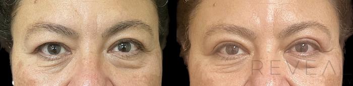 Before & After Eyelid Surgery Case 731 Front View in San Jose, CA