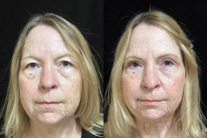 Before & After Eyelid Surgery Case 733 Front View in San Jose, CA