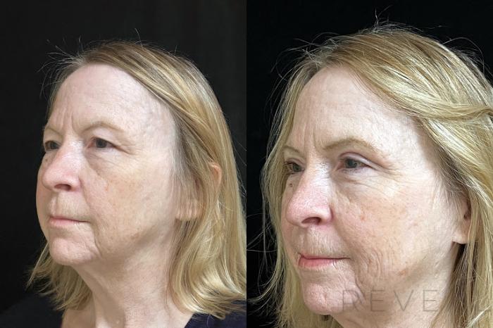 Before & After Eyelid Surgery Case 733 Left Side View in San Jose, CA