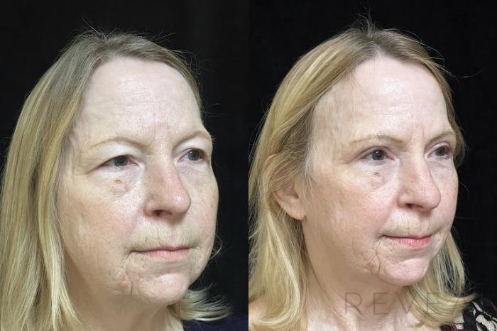 Before & After Eyelid Surgery Case 733 Right Side View in San Jose, CA