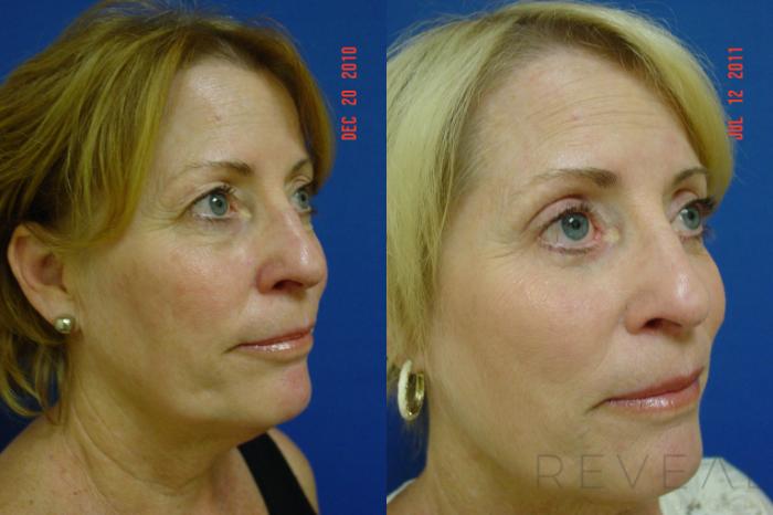 Before & After Eyelid Surgery Case 75 View #1 View in San Jose, CA