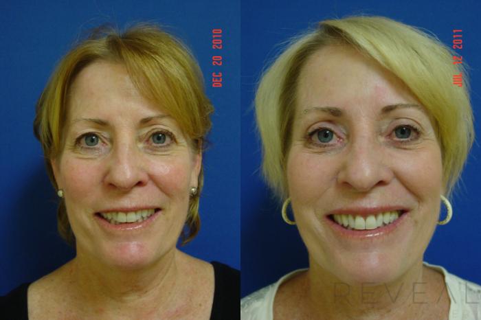 Before & After Eyelid Surgery Case 75 View #2 View in San Jose, CA