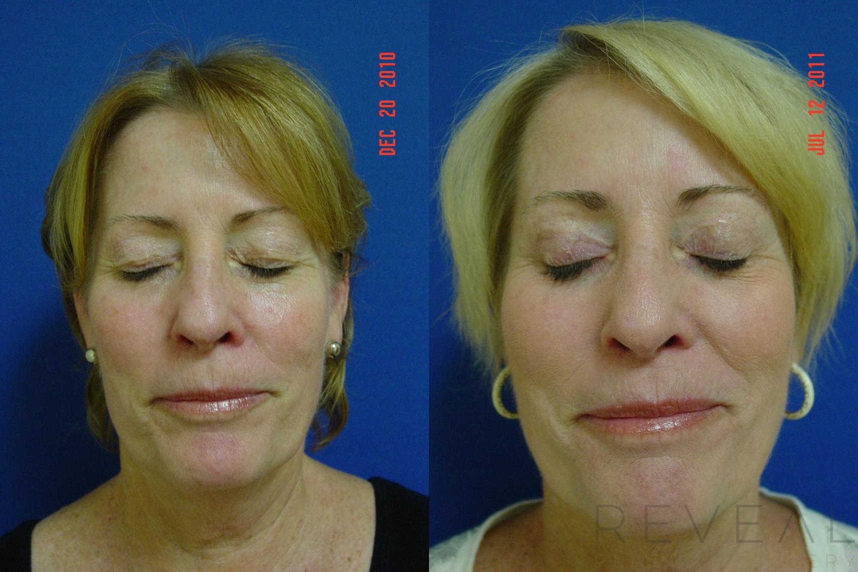 Before & After Liposuction Case 75 View #3 View in San Jose, CA