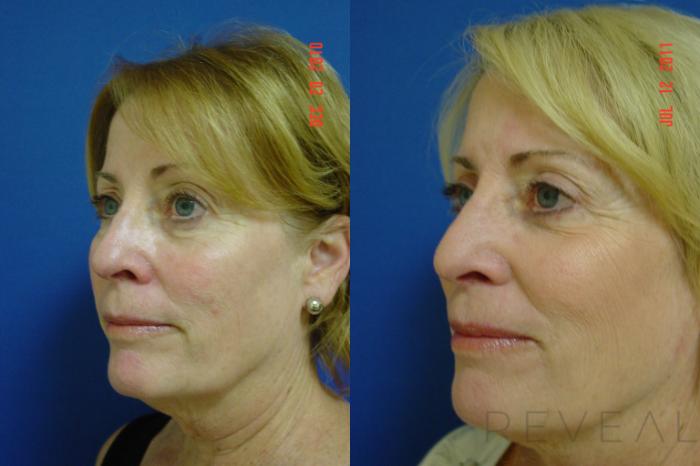 Before & After Eyelid Surgery Case 75 View #4 View in San Jose, CA