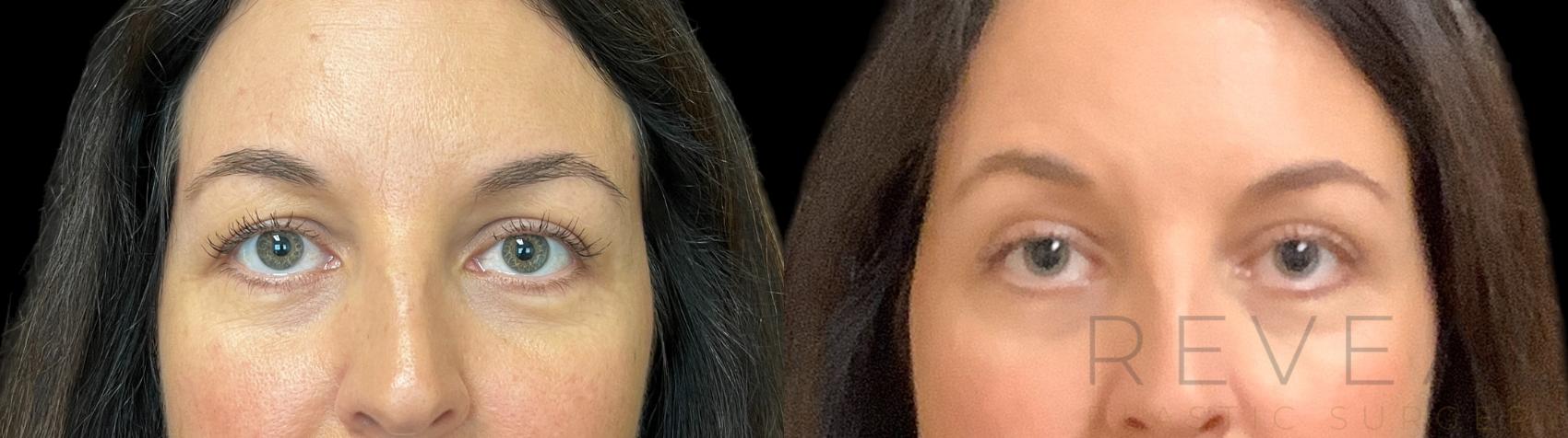 Before & After Eyelid Surgery Case 780 Front View in San Jose, CA