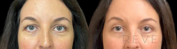 Before & After Eyelid Surgery Case 780 Front View in San Jose, CA