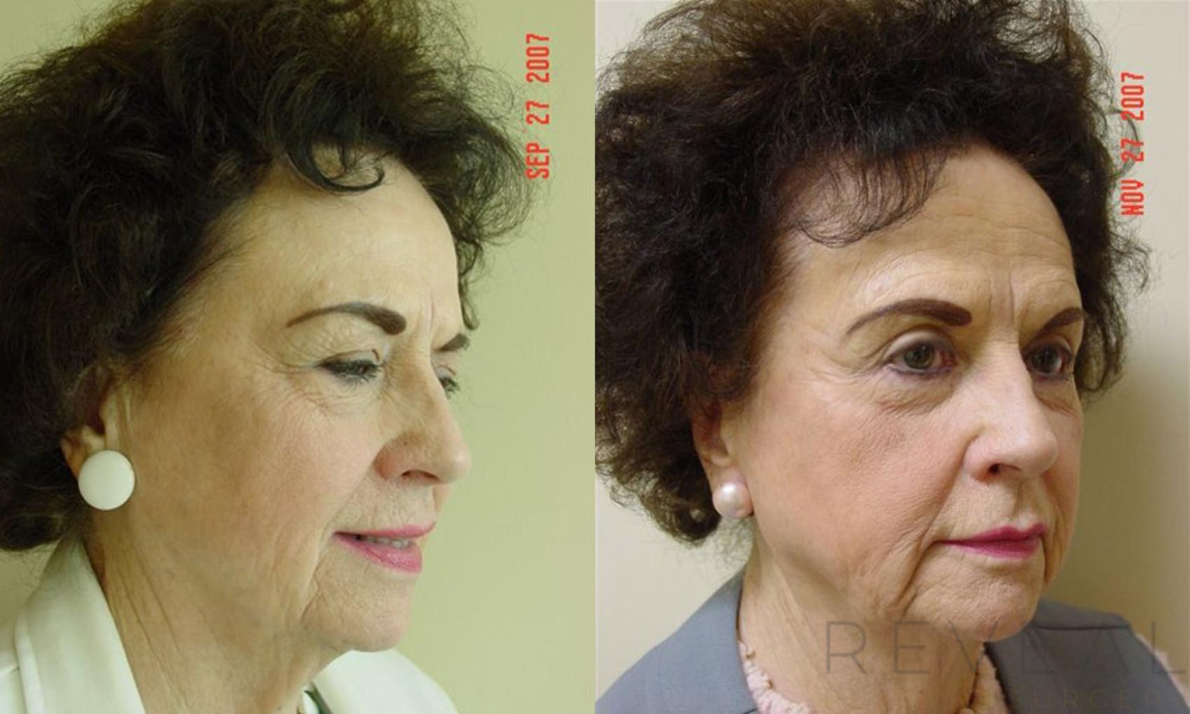 Before & After Eyelid Surgery Case 8 View #1 View in San Jose, CA