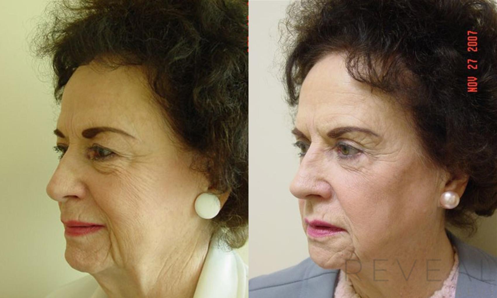 Before & After Eyelid Surgery Case 8 View #4 View in San Jose, CA