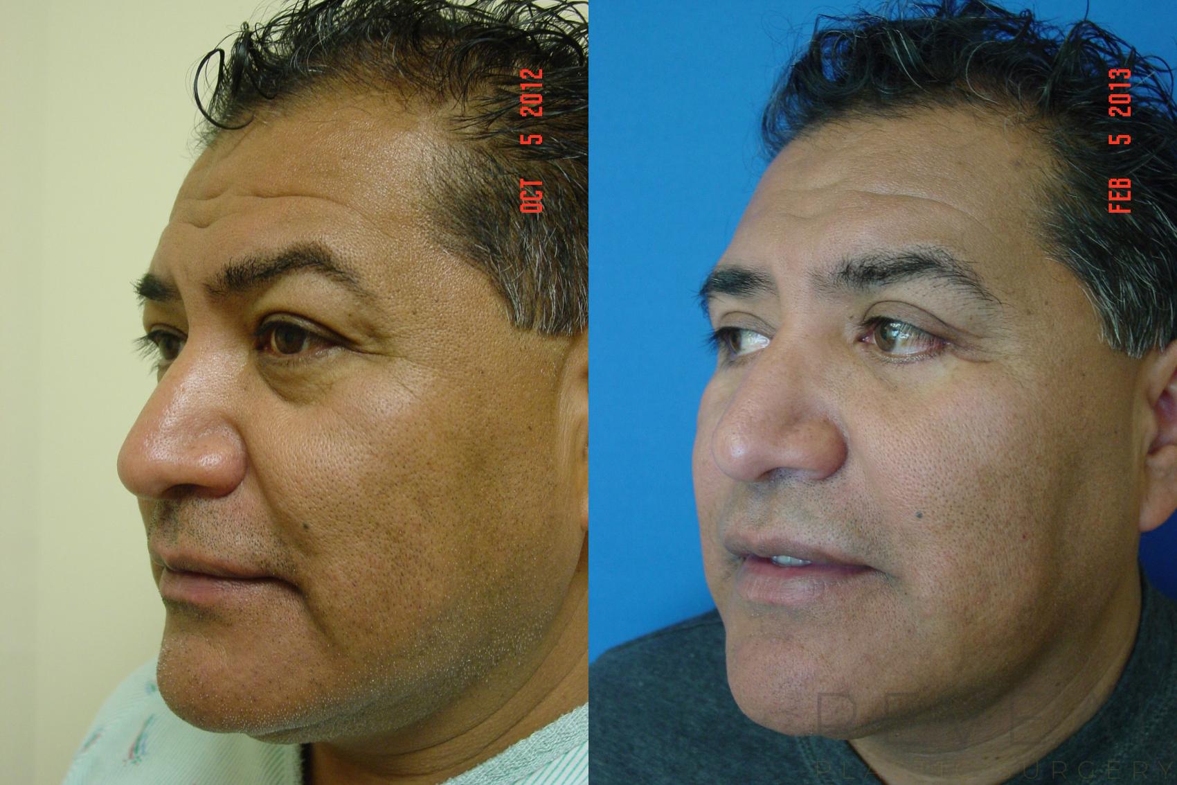Before & After Eyelid Surgery Case 97 View #1 View in San Jose, CA