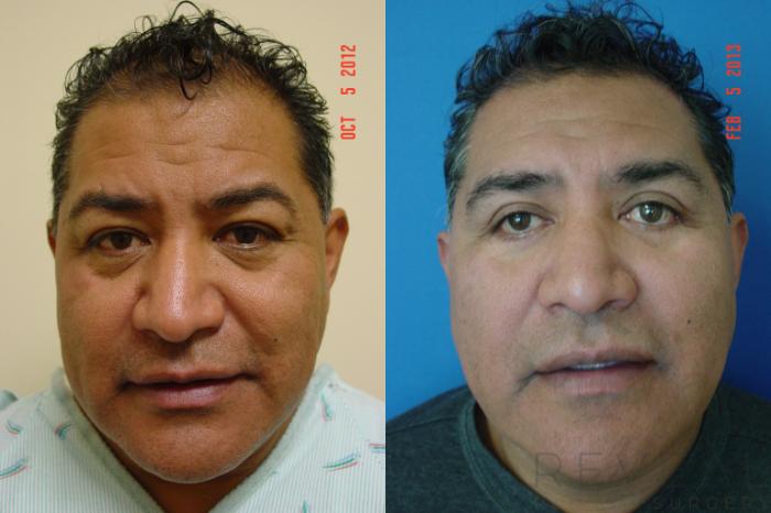 Before & After Eyelid Surgery Case 97 View #2 View in San Jose, CA