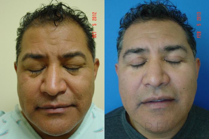 Before & After Eyelid Surgery Case 97 View #3 View in San Jose, CA