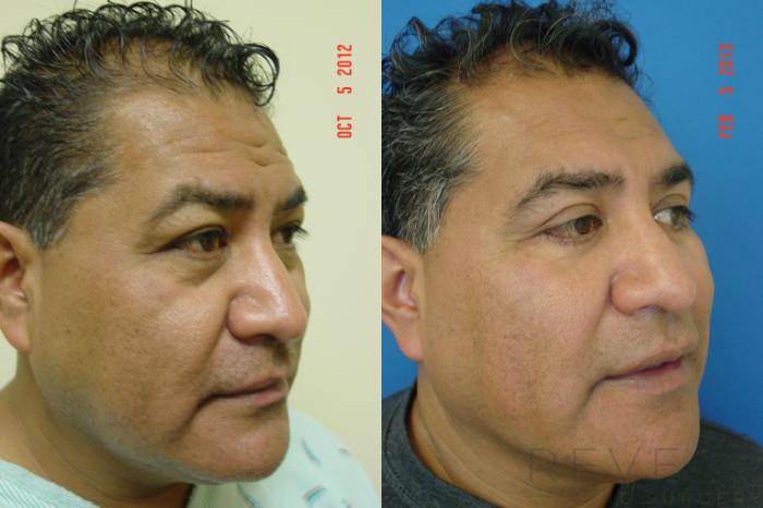 Before & After Eyelid Surgery Case 97 View #4 View in San Jose, CA