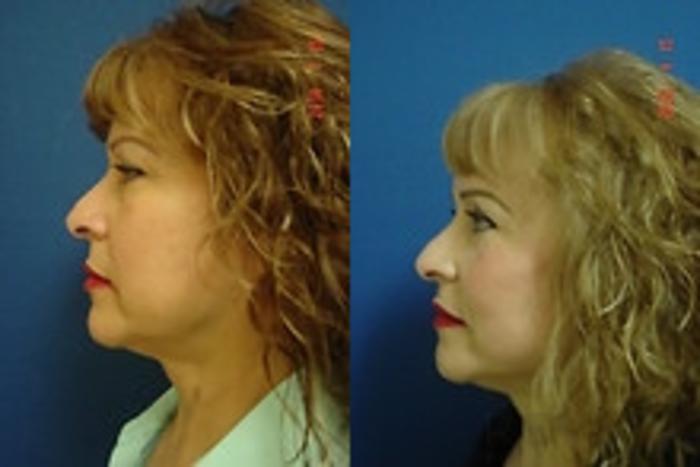 Before & After Neck Lift Case 176 View #2 View in San Jose, CA