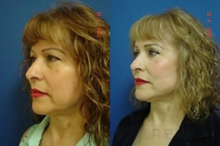 Before & After Eyelid Surgery Case 176 View #3 View in San Jose, CA