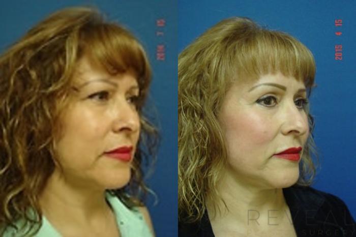 Before & After Eyelid Surgery Case 176 View #4 View in San Jose, CA