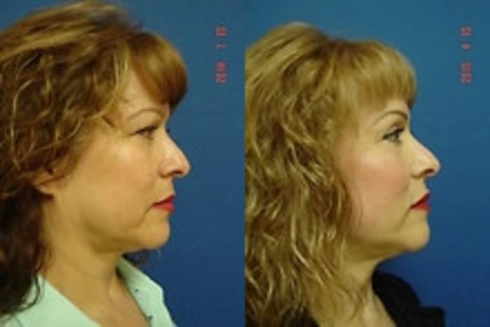 Before & After Eyelid Surgery Case 176 View #5 View in San Jose, CA