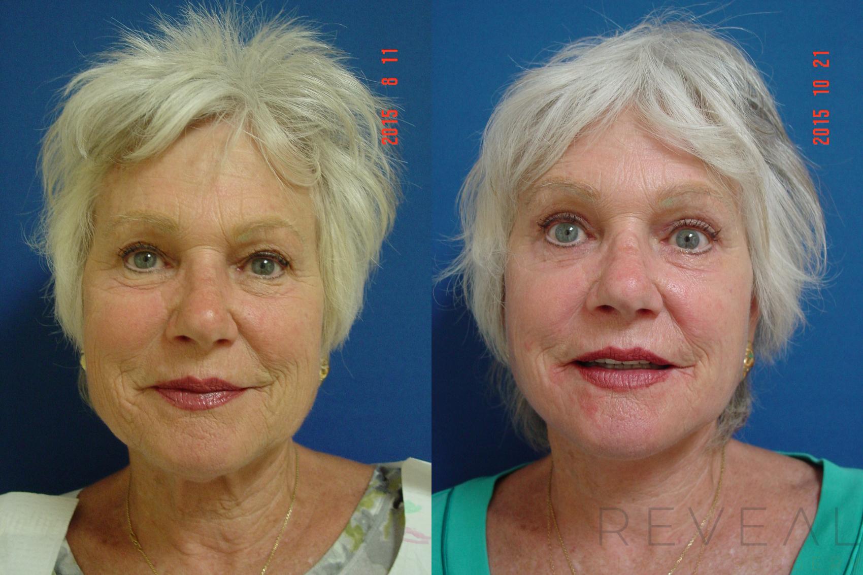 Before & After Facelift Case 182 View #1 View in San Jose, CA