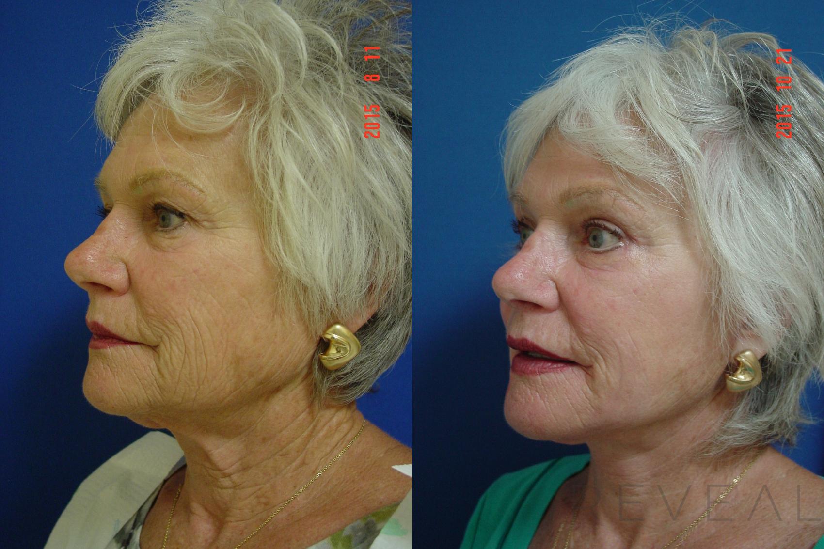 Before & After Facelift Case 182 View #2 View in San Jose, CA