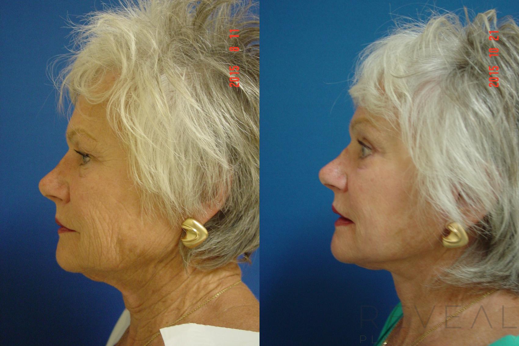 Before & After Facelift Case 182 View #3 View in San Jose, CA