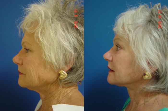 Before & After Eyelid Surgery Case 182 View #3 View in San Jose, CA