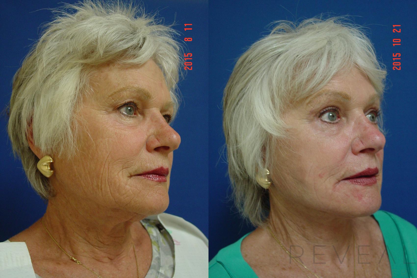 Before & After Facelift Case 182 View #4 View in San Jose, CA
