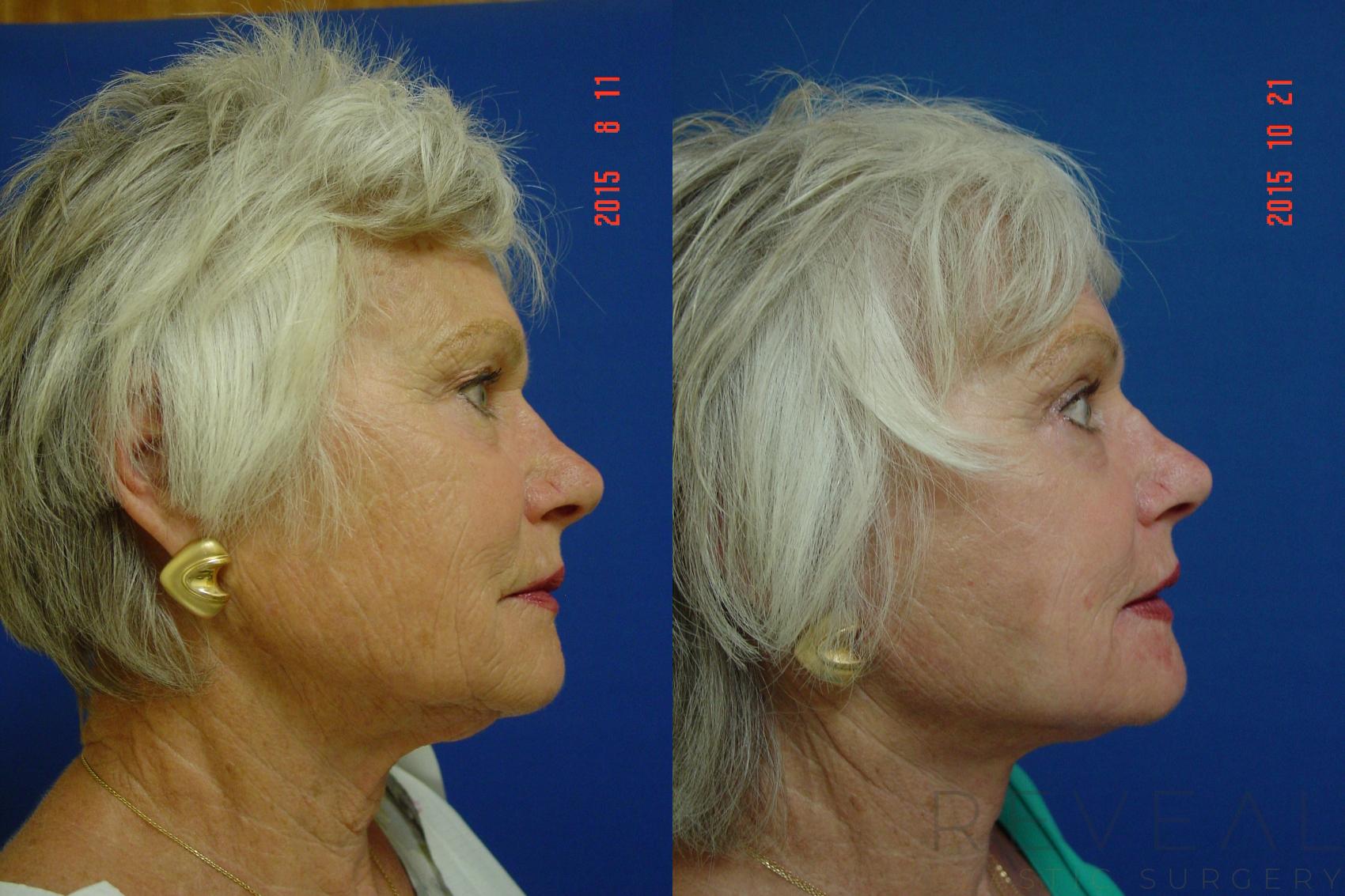 Before & After Facelift Case 182 View #5 View in San Jose, CA