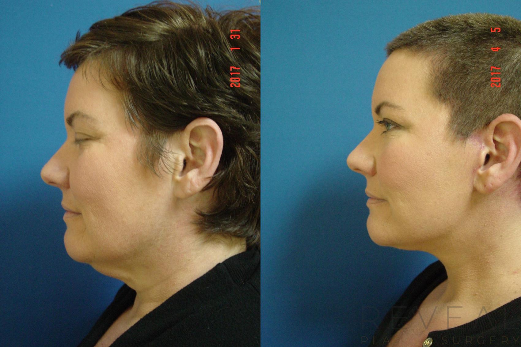 Before & After Neck Lift Case 209 View #1 View in San Jose, CA