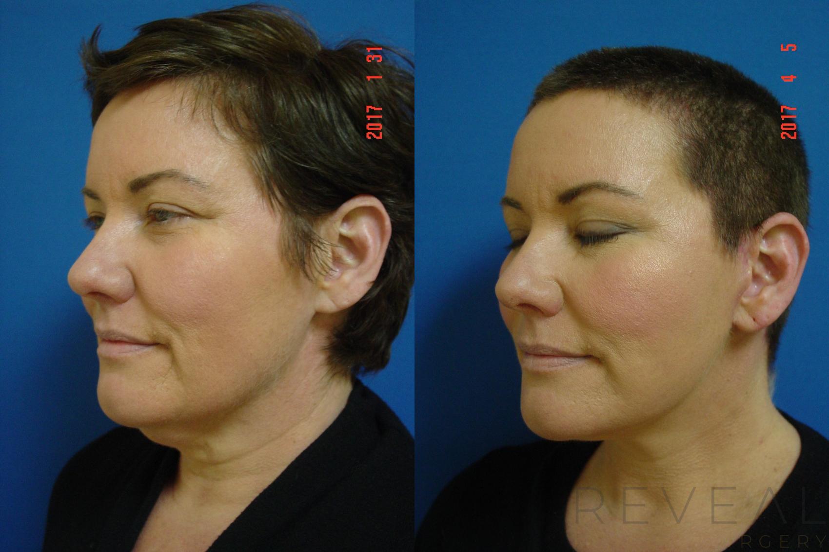 Before & After Facelift Case 209 View #2 View in San Jose, CA