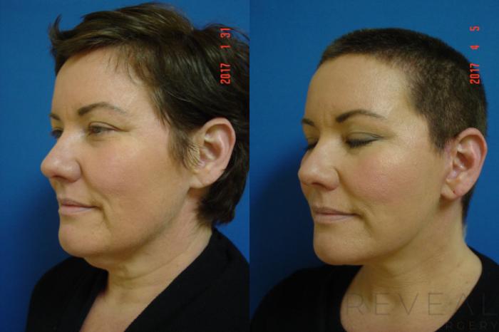 Before & After Neck Lift Case 209 View #2 View in San Jose, CA