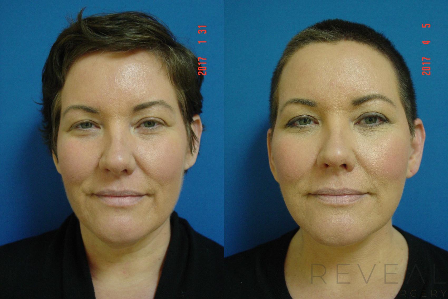Before & After Facelift Case 209 View #3 View in San Jose, CA