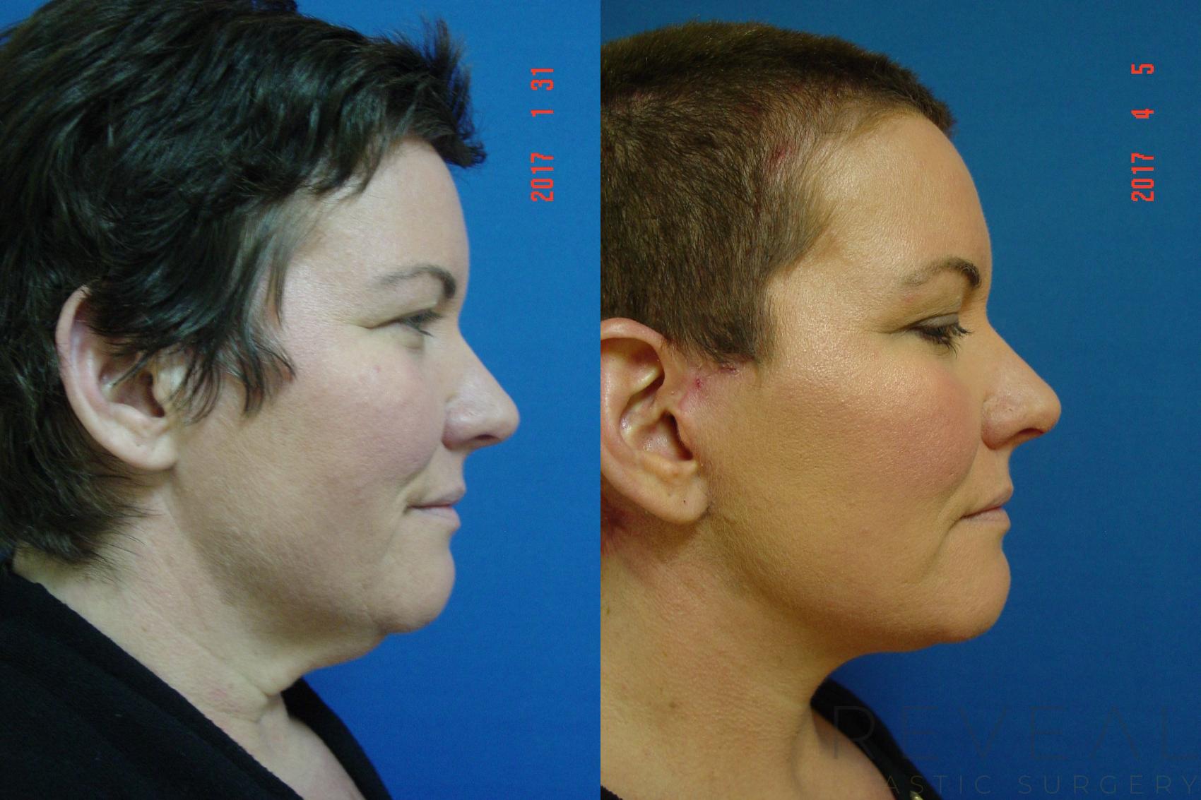 Before & After Facelift Case 209 View #4 View in San Jose, CA