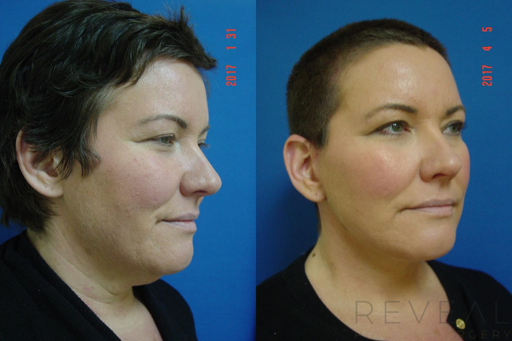 Before & After Facelift Case 209 View #5 View in San Jose, CA