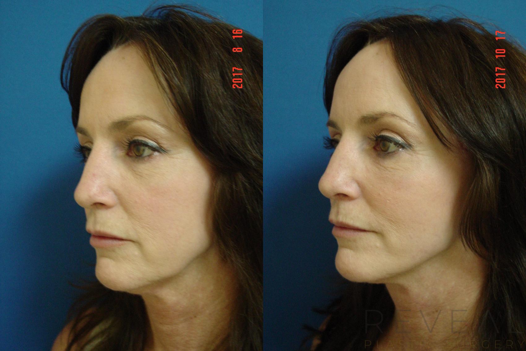 Before & After Facelift Case 234 View #2 View in San Jose, CA