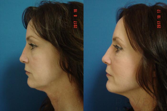 Before & After Eyelid Surgery Case 234 View #3 View in San Jose, CA