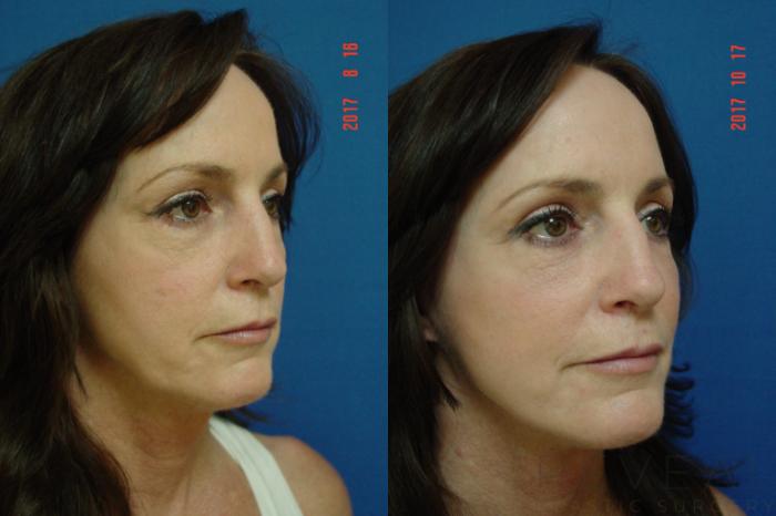 Before & After Eyelid Surgery Case 234 View #4 View in San Jose, CA