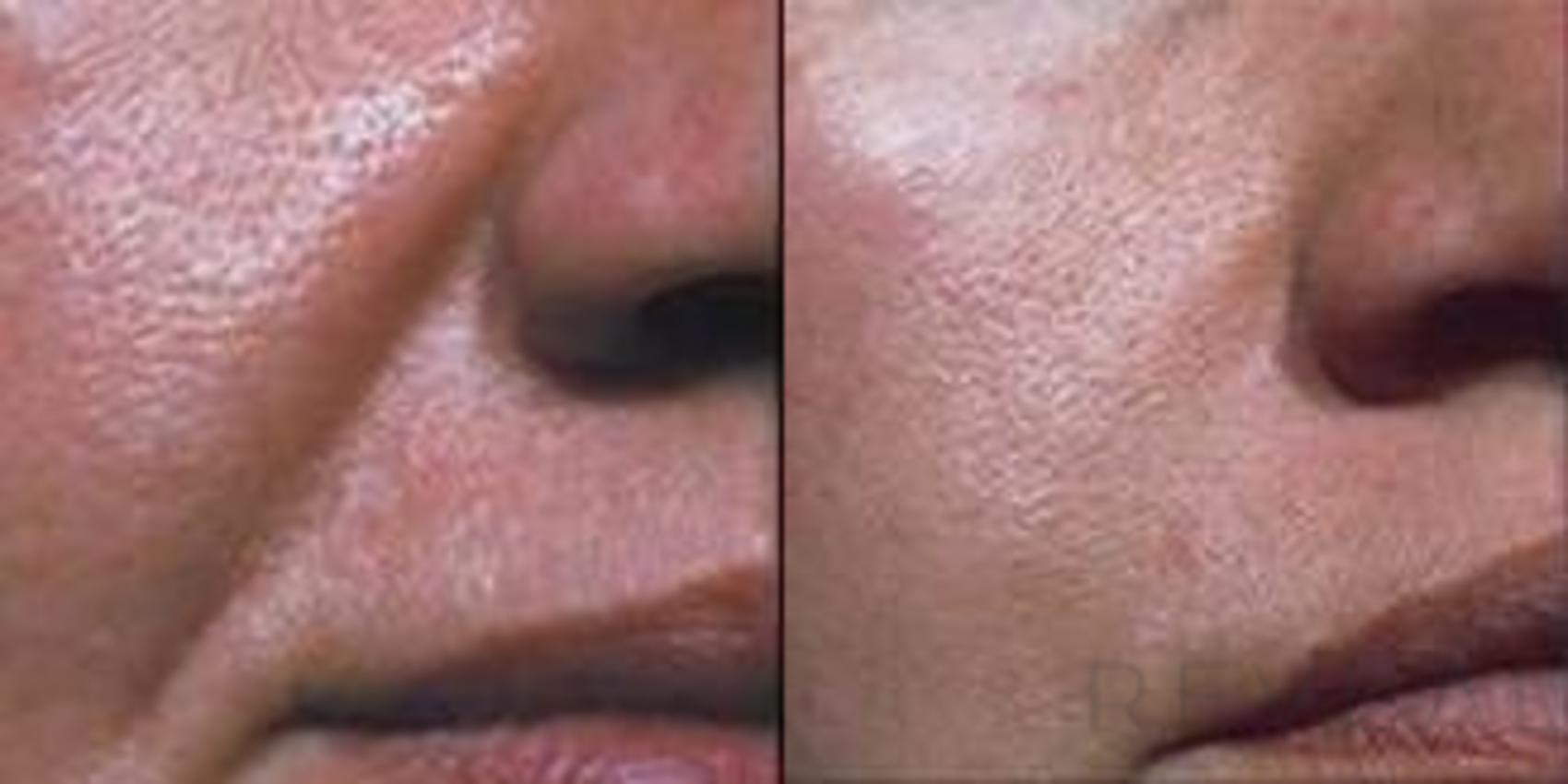 Before & After Peels & Resurfacing Case 31 View #1 View in San Jose, CA