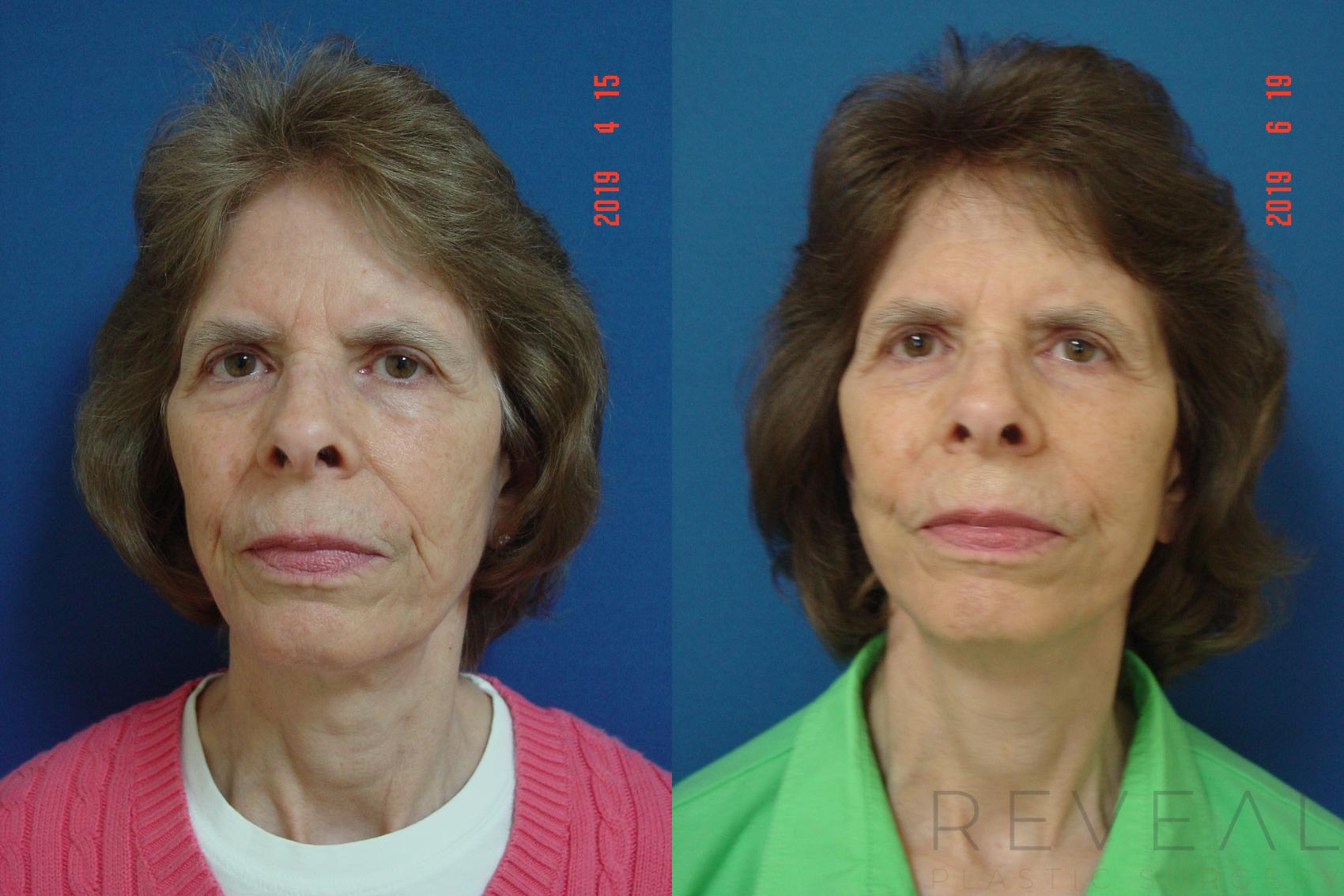Before & After Neck Lift Case 340 View #1 View in San Jose, CA