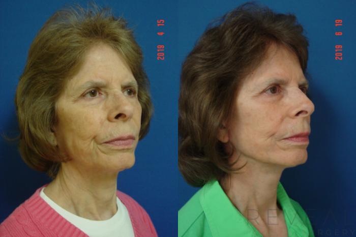 Before & After Neck Lift Case 340 View #2 View in San Jose, CA