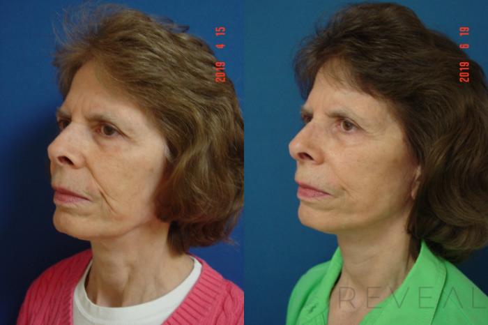 Before & After Neck Lift Case 340 View #3 View in San Jose, CA