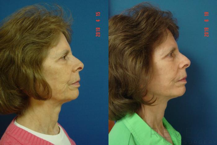 Before & After Facelift Case 340 View #4 View in San Jose, CA