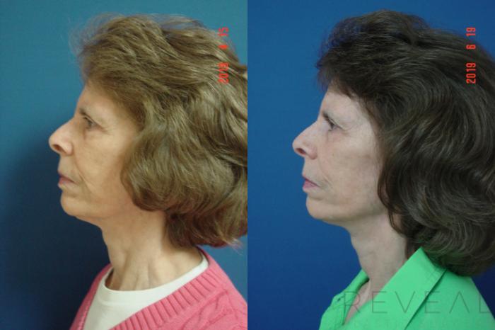 Before & After Neck Lift Case 340 View #5 View in San Jose, CA