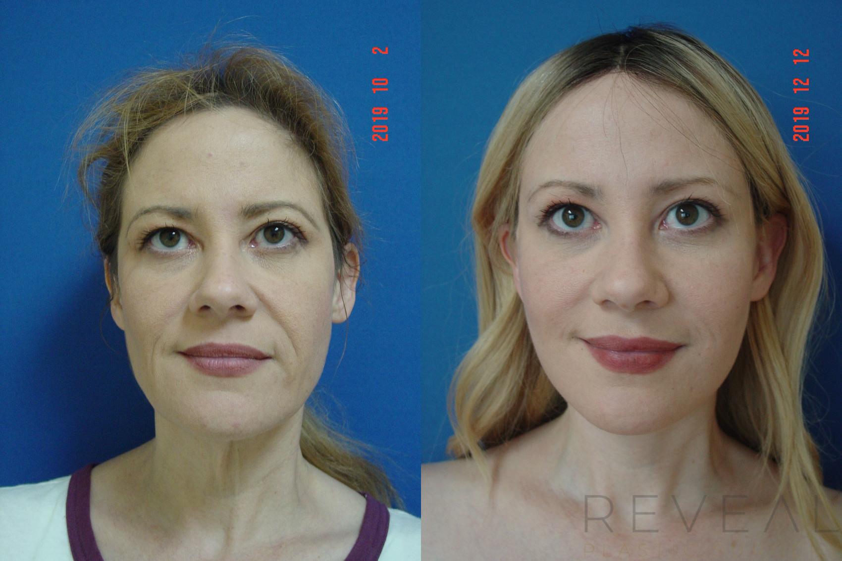 Before & After Facelift Case 381 View #2 View in San Jose, CA