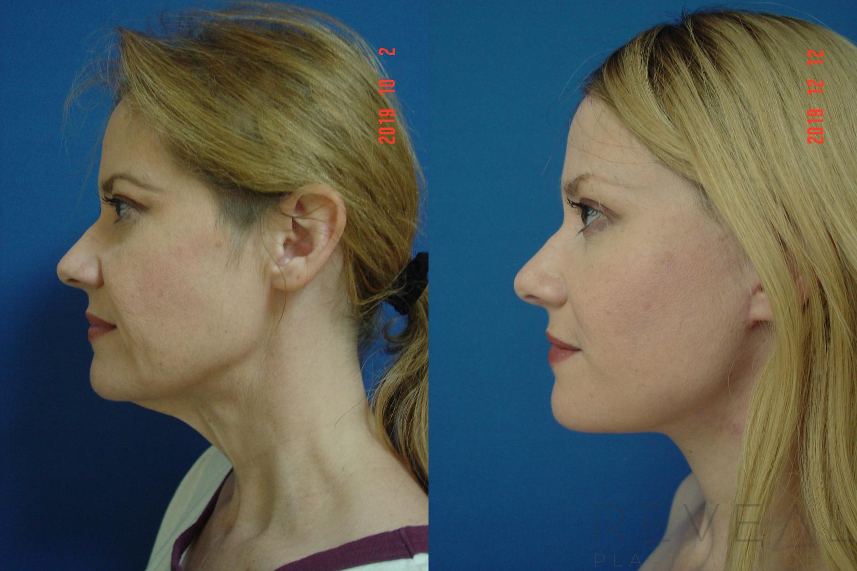 Before & After Facelift Case 381 View #3 View in San Jose, CA