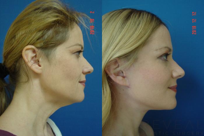 Before & After Neck Lift Case 381 View #5 View in San Jose, CA