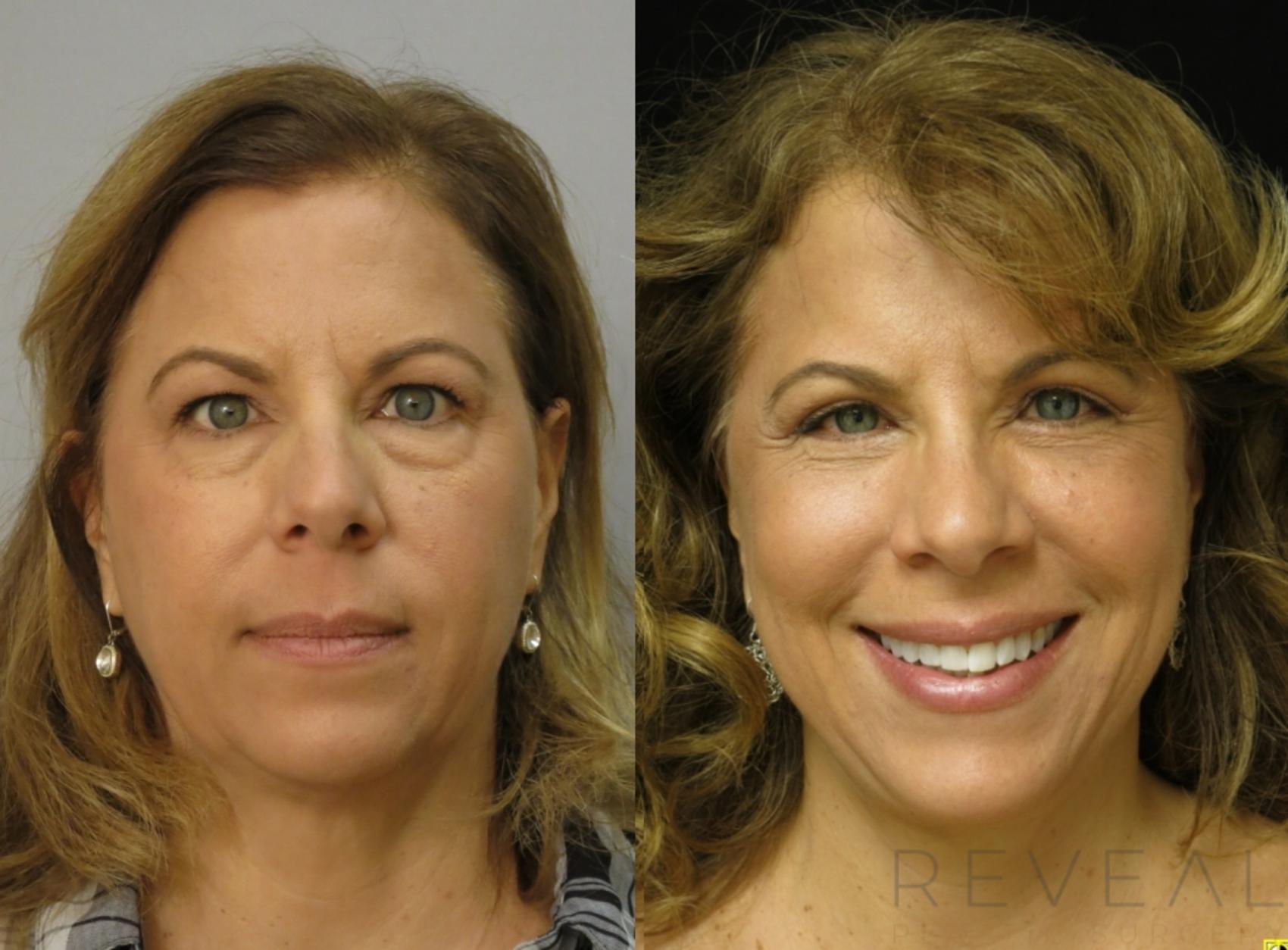 Before & After Eyelid Surgery Case 411 View #1 View in San Jose, CA