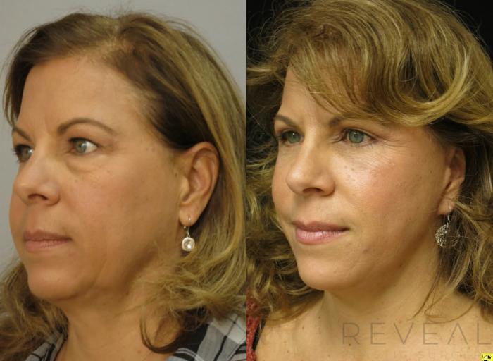 Before & After Eyelid Surgery Case 411 View #2 View in San Jose, CA