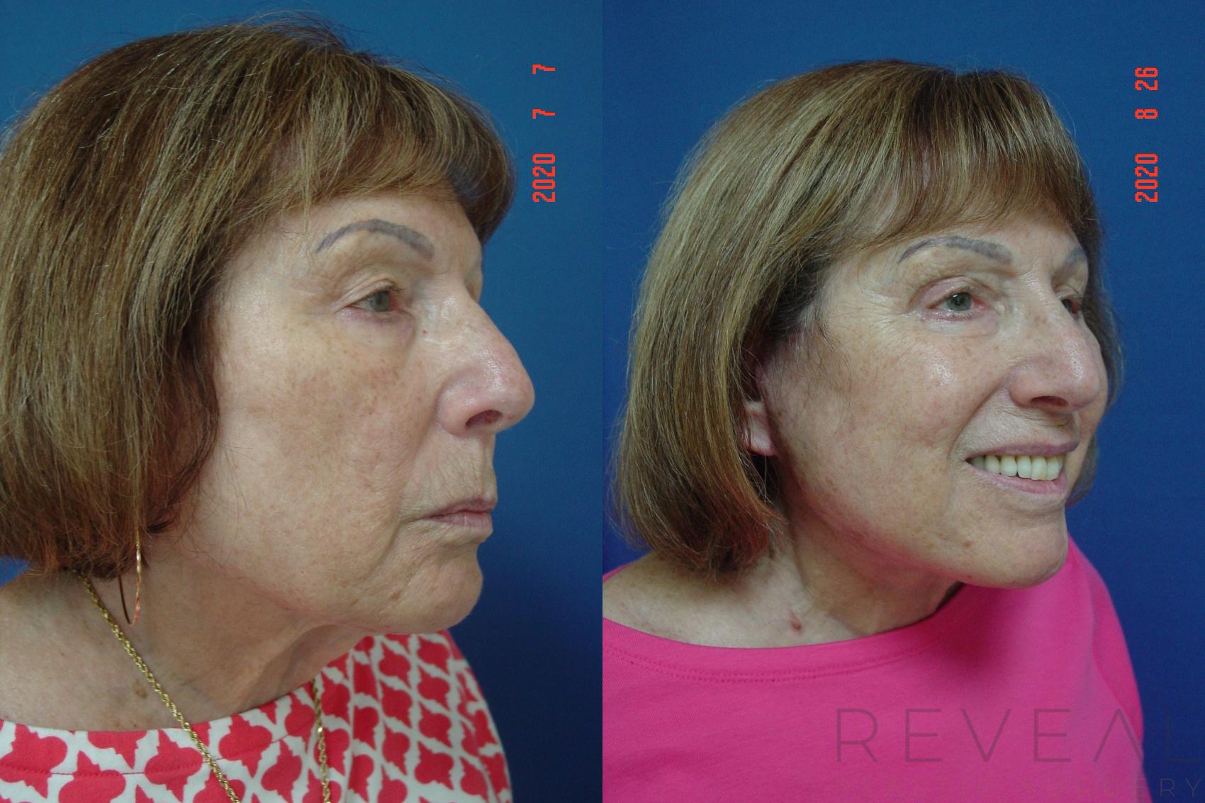 Before & After Facelift Case 415 View #1 View in San Jose, CA